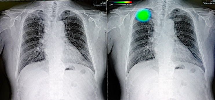 AIが胸部で対象所見と疑わしいものを表示した画像例