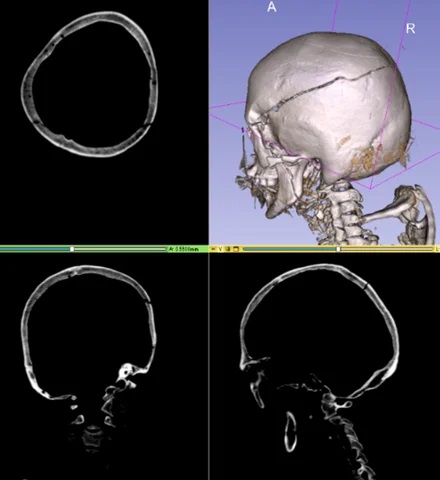 医用3D画像データ