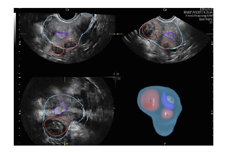 子宮筋腫と子宮、子宮内膜との位置関係を立体表示する「Fibroid Mapping」