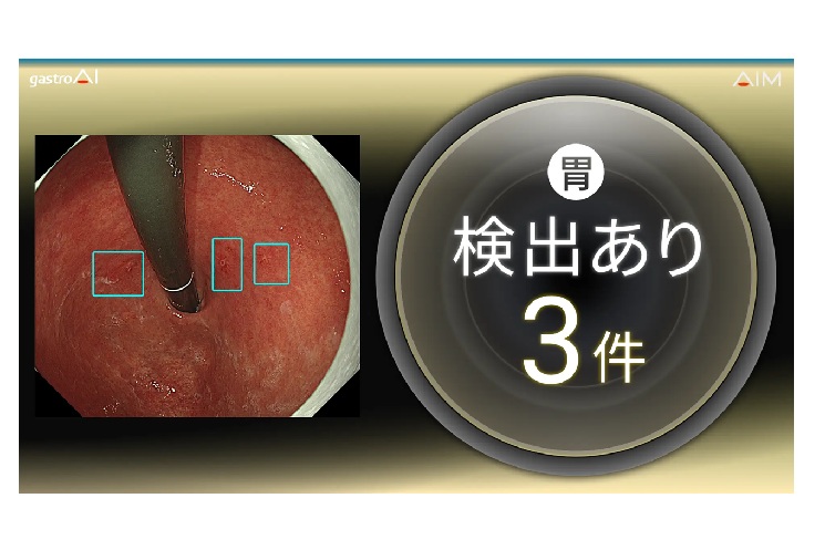 早期胃がんと腺腫に画像上で類似した領域の検出イメージ