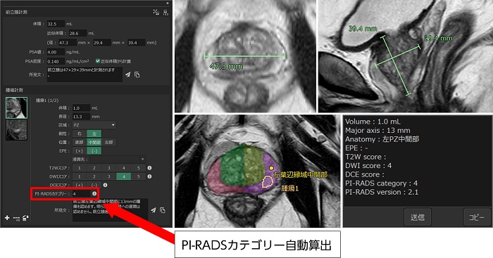 前立腺ビューでの読影支援機能。腫瘍計測をすると、自動で腫瘍のサイズ、区域、側性などを表示するほか、医師が選択した画像スコアに基づき、PI-RADSカテゴリーを自動算出する