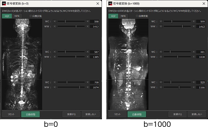 「Body DWIビュー(MR)」の自動スティッチング機能と自動信号値補正機能のイメージ