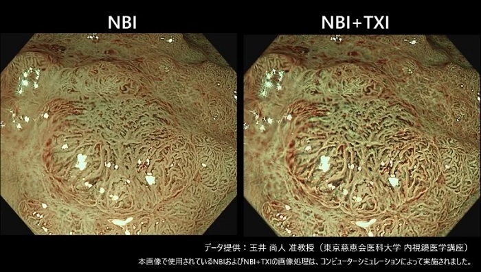 「NBIモード」(左)と「NBI+TXIモード」の比較イメージ