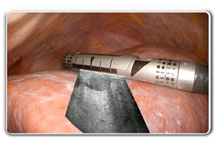 超音波画像重畳AI技術