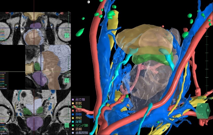 「膀胱周辺臓器解析」の解析画面