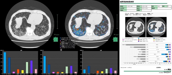 間質性肺疾患解析画面とレポート
