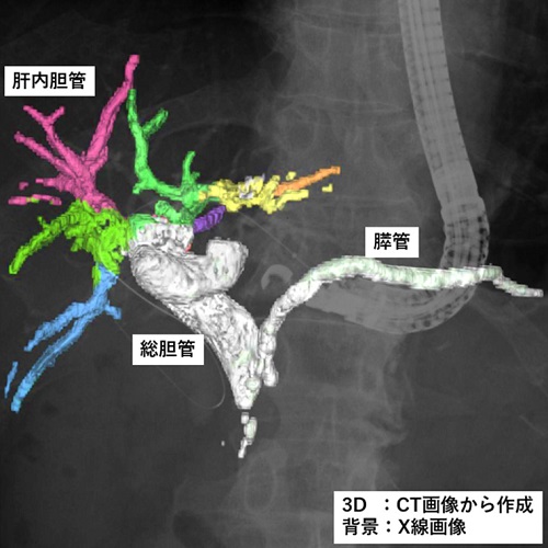 ERCP中に撮影したX線透視画像上にCT画像で作成した胆管・膵管3D像を重畳表示している様子