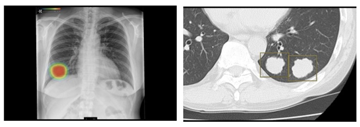 （左から）「胸部X線CADサービス」「肺結節検出サービス」