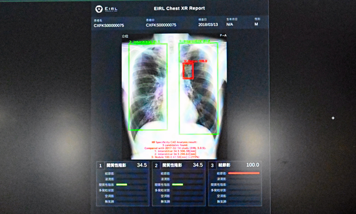 新技術を搭載した「EIRL Chest Screening」の画面