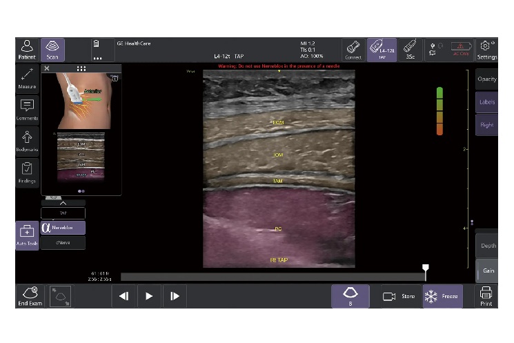Nervebloxによる神経ブロックのサポート (中央）Anatomical Labeling:画像上に解剖学的ラベルを略語形式で表示 (右上）Quality Meter:表示画像の品質をリアルタイムで評価して色分け表示