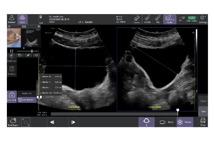 Auto Bladder Volumeにより2断面から半自動的に膀胱容積を計算