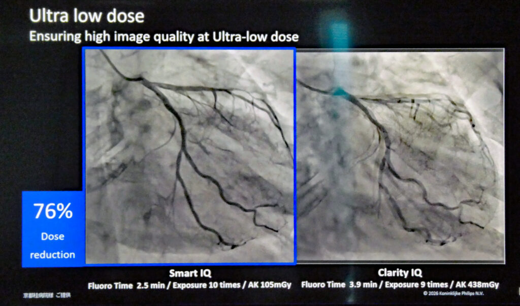「Ultralow Dose」でX線量を76％低減した撮影例