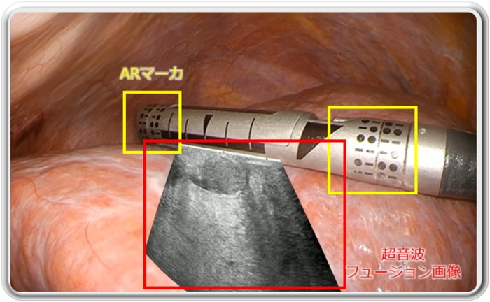 「超音波フラッグAR」の画面イメージ。手術中の肝臓の内視鏡映像に重ねて、腹腔(ふくくう)鏡下のプローブで得られる超音波画像を表示できる