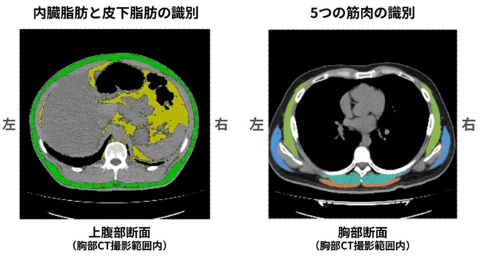 脂肪と筋肉の識別イメージ