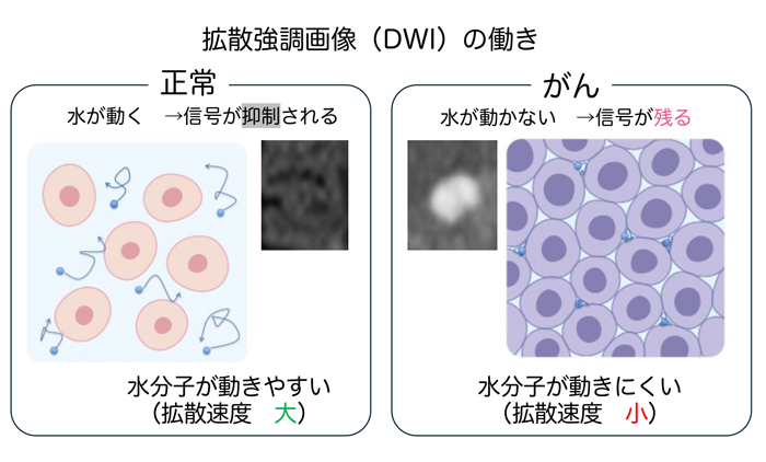 「拡散強調画像（DWI）」は正常組織とがん組織で水分子の動きが異なる性質を利用する