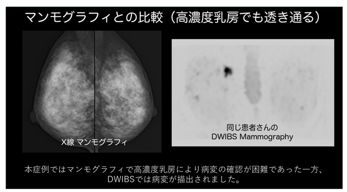 「高濃度乳房」でマンモグラフィーでは確認が難しかった病変を、「DWIBS」で描出した症例